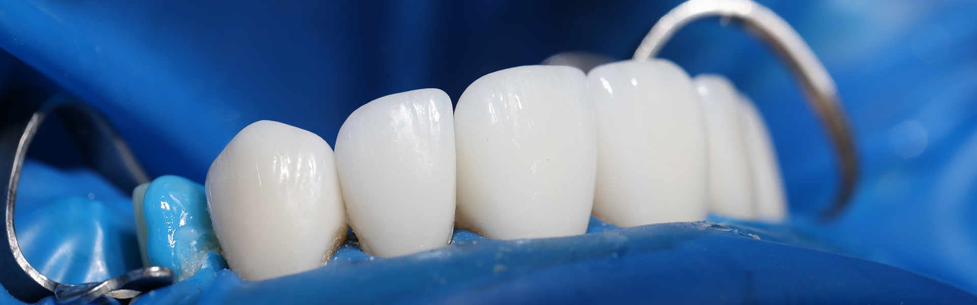 Signs Your Dental Bridge Needs Repair or Replacement