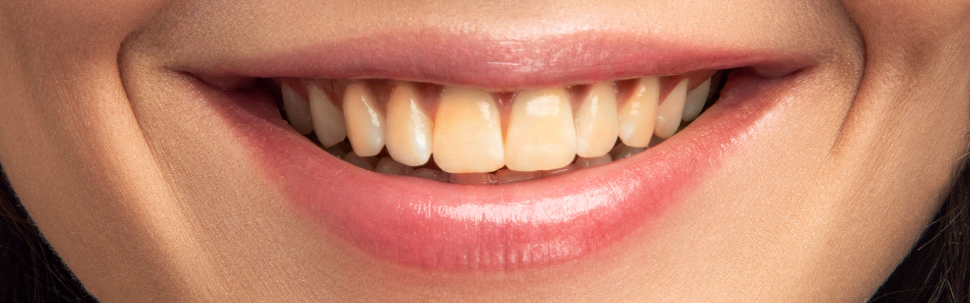 What Causes Yellow Teeth and How Professional Whitening Helps