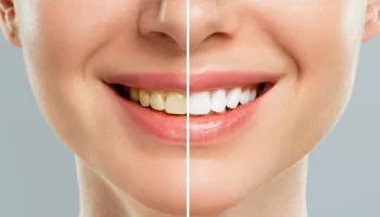 Get a Camera-Ready Smile with Professional Whitening in Huntington Beach